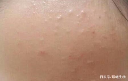 去油很重要肌肤清洁要到位另外,面部的脂肪堆积在皮下形成脂肪粒,也