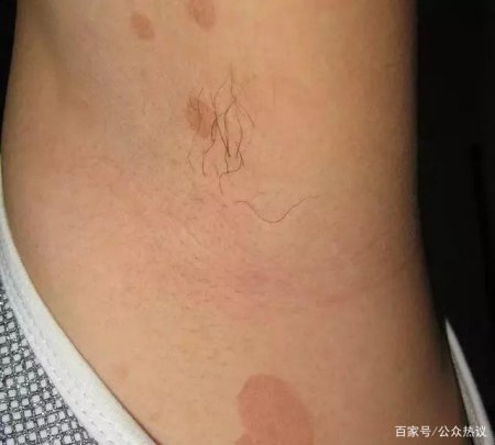 一到夏天胸背腋窝出现棕色圆形斑点,是什么?会传染吗?