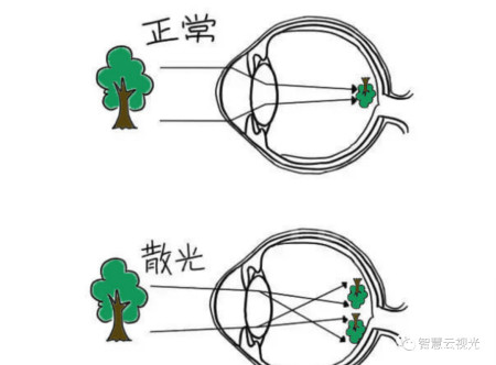 1什麼是散光眼球在不同子午線上屈光力不同,進入眼球的光線不能在