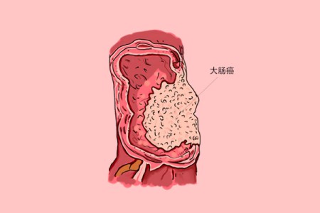 腸道息肉會發展為大腸癌?大腸癌的形成條件是什麼?如何防治?